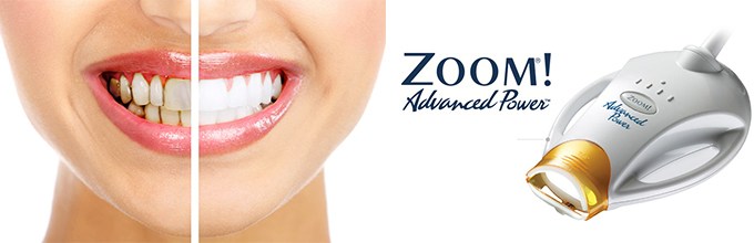 Новости: Икар-Дент представляет программу Отбеливание зубов Zoom для здоровой улыбки своих пациентов!