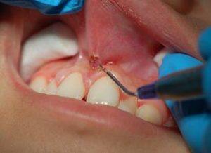 Подрезание уздечки губы
