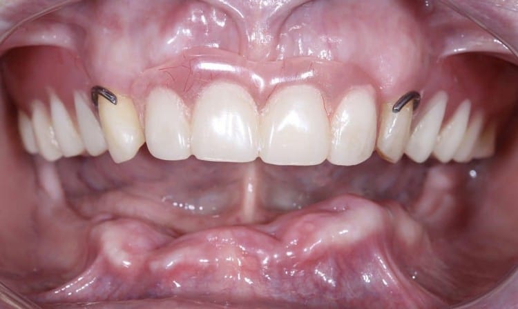 Ситуация в полости рта после удаления зубов и изготовления временного съемного протеза верхней челюсти