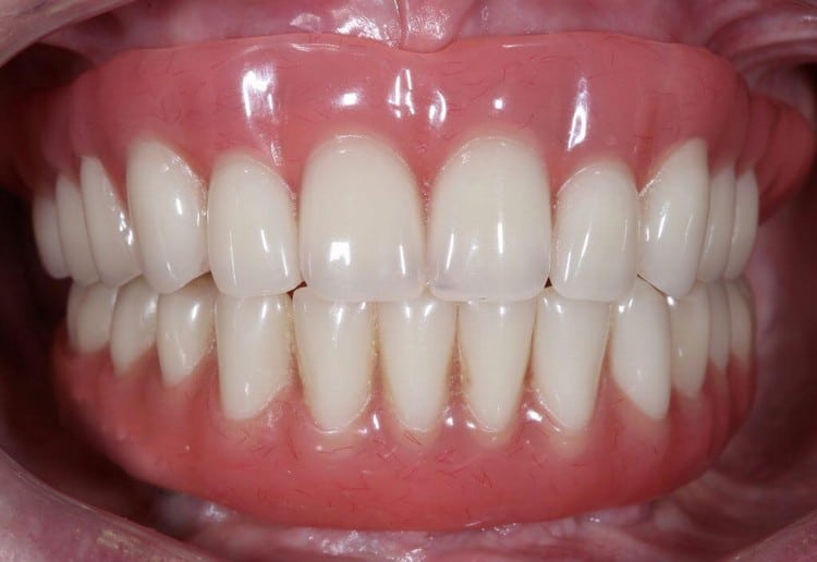 Протез Trefoil после коррекции и перебазировки в зуботехнической лаборатории