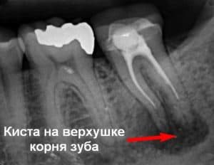 Снимок кисты зуба