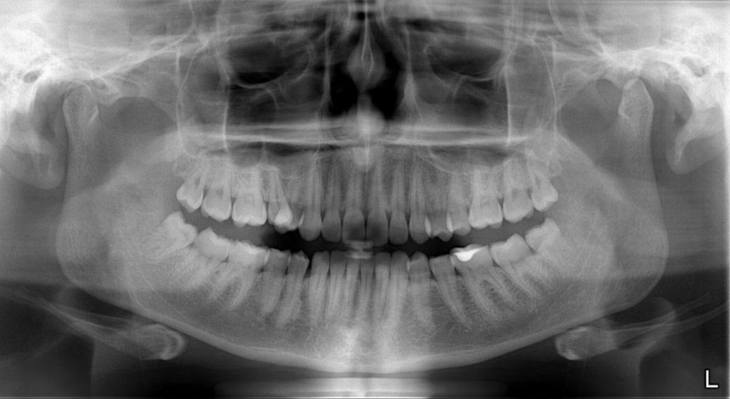 Панорманый снимок зубов - ортопантомограмма