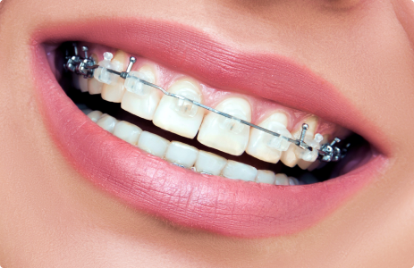 КЕРАМИЧЕСКИЕ БРЕКЕТЫ