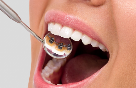 Лингвальные брекеты