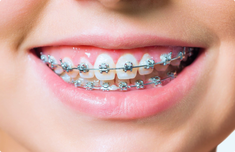 Металлические брекеты