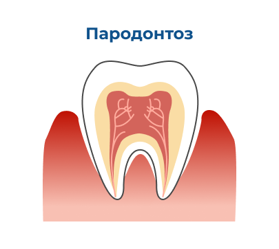 Лечение пародонтоза