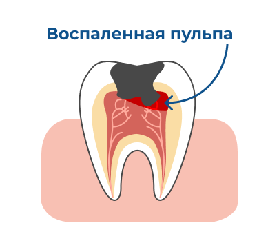 Воспаленная пульпа