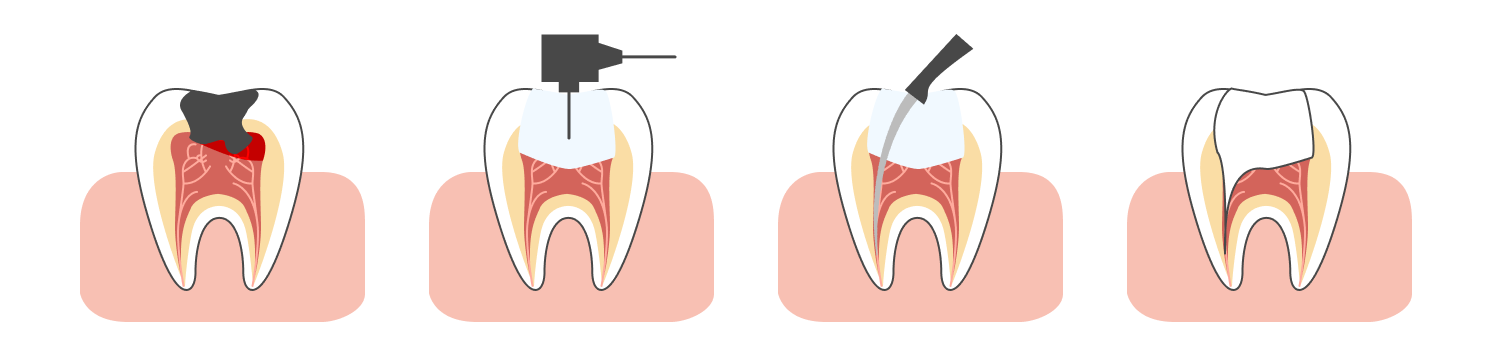 Процесс лечения пульпита