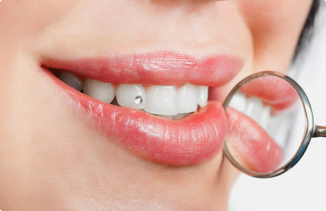 скайс на зубе