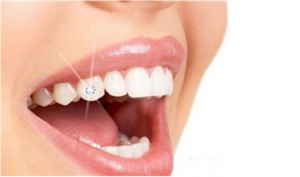 Новая услуга в клинике Икар-Дент: установка украшение на зуб